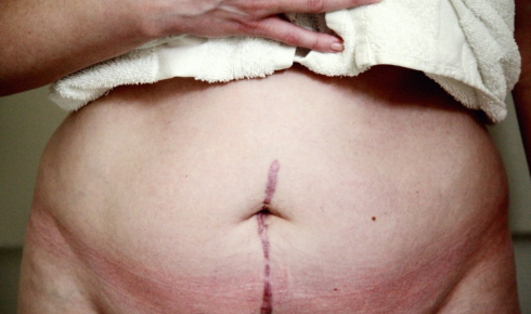 what to wear after inguinal hernia surgery